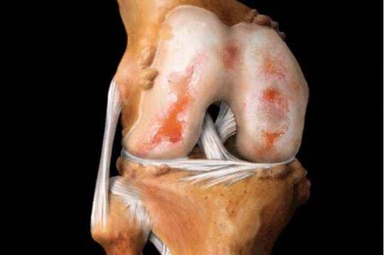 повреждение коленного сустава при артрозе
