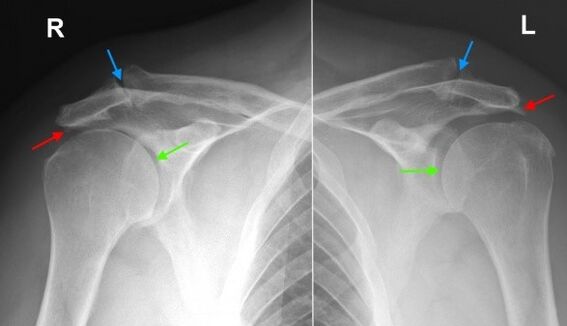 Рентген плечевых суставов